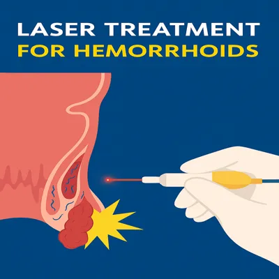 لیزر نوین بواسیر با بهبود سریع و بدون بخیه و نقاهت طولانی
