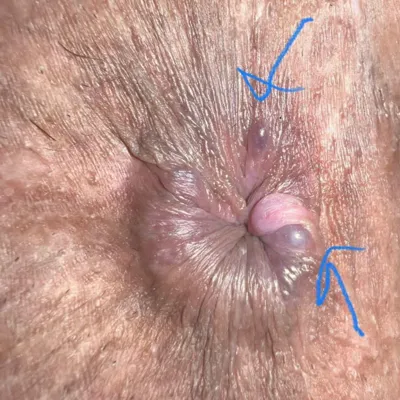 بیرون‌زدگی هموروئید خارجی همراه با تورم شدید