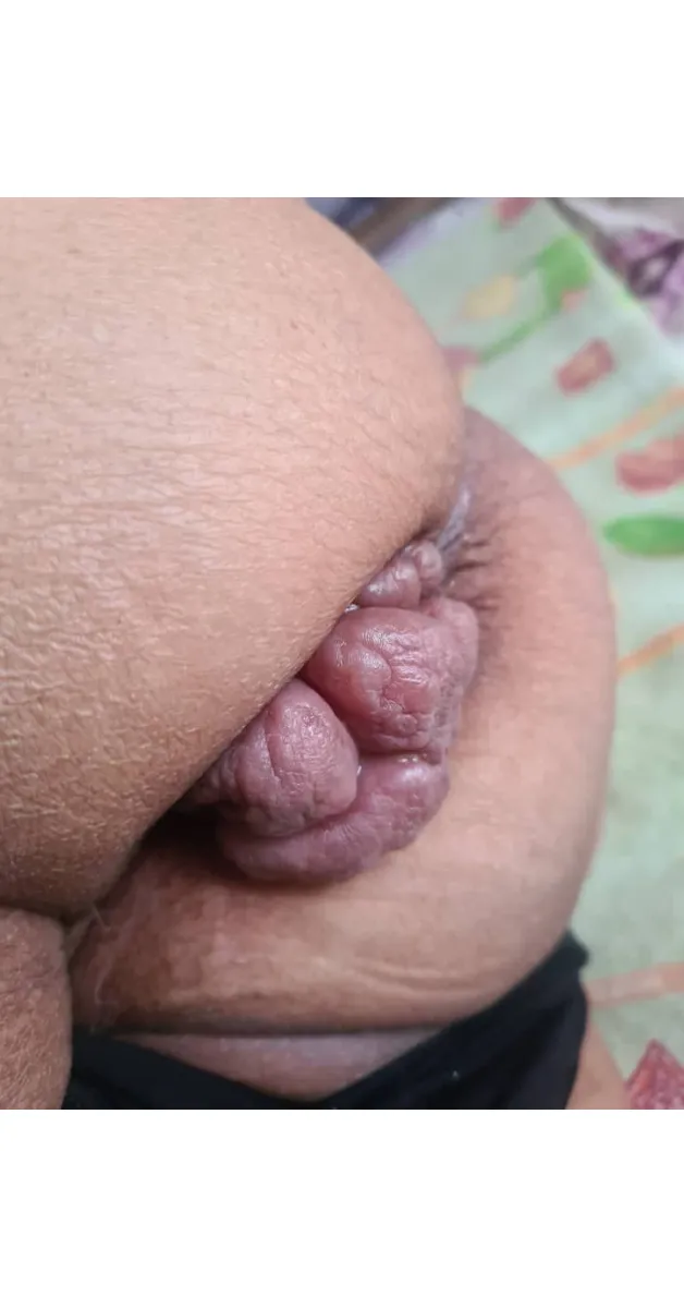 تجربه عمل بواسیر با لیزر