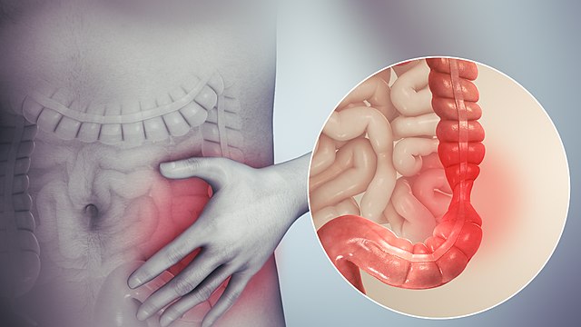 التهاب روده چیست؟