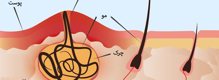 تشخیص کیست مویی