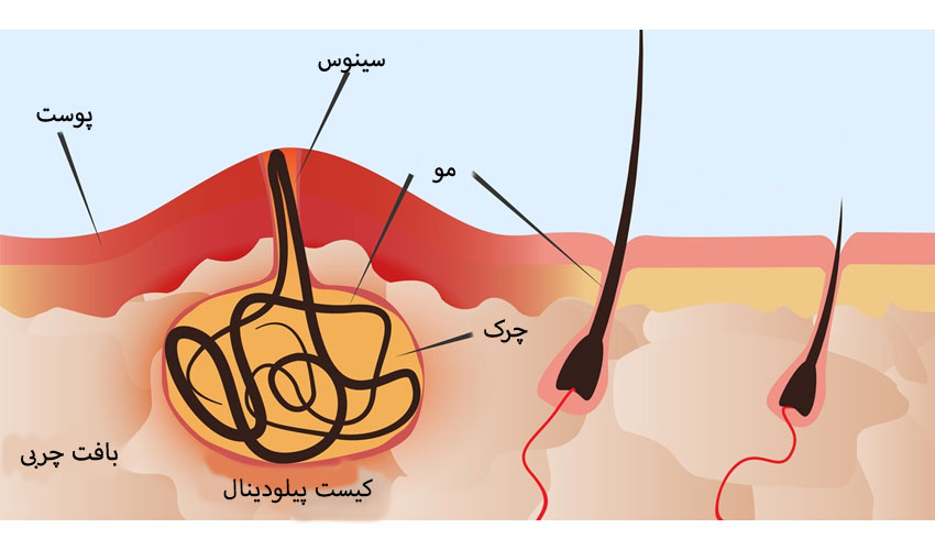 تشخیص کیست مویی