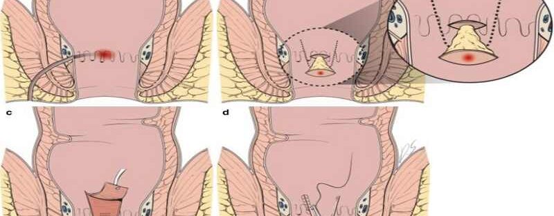 روش های جراحی فیستول مقعدی