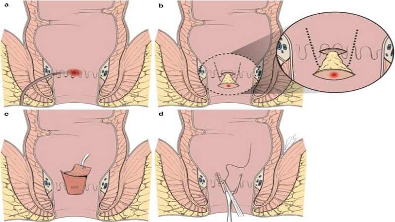 روش های جراحی فیستول مقعدی