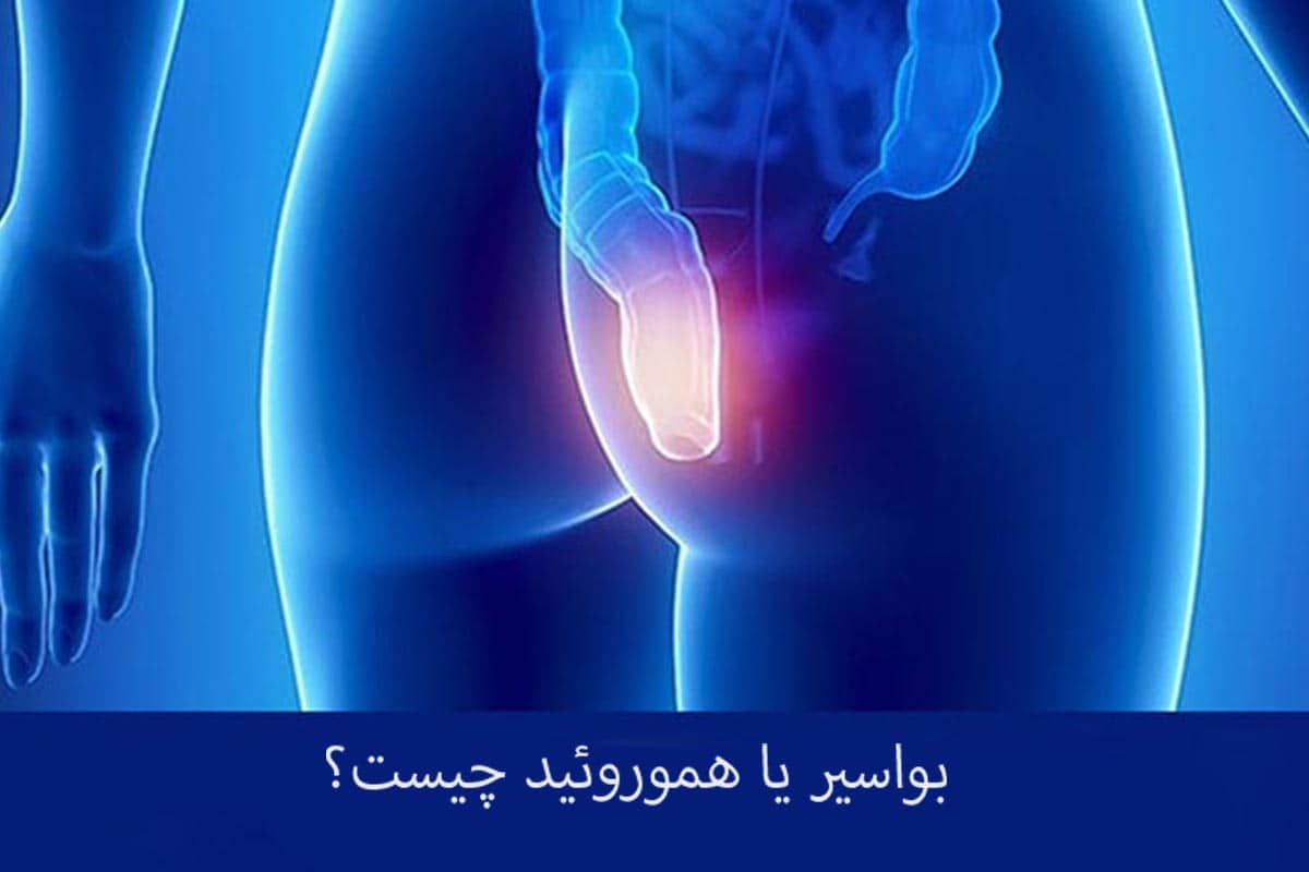 هموروئید (بواسیر) چیست و چه علائمی دارد؟