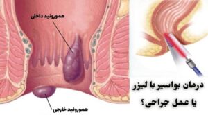 هموروئید (بواسیر) یکی از انواع بیماری های مقعدی می باشد که اگر هموروئید خارجی داشته باشید بهترین درمان درمان با لیزر می باشد.