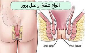 شقاق یک برش یا پارگی در ناحیه ی مقعد است.