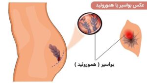 علائم بواسیر در خانم ها