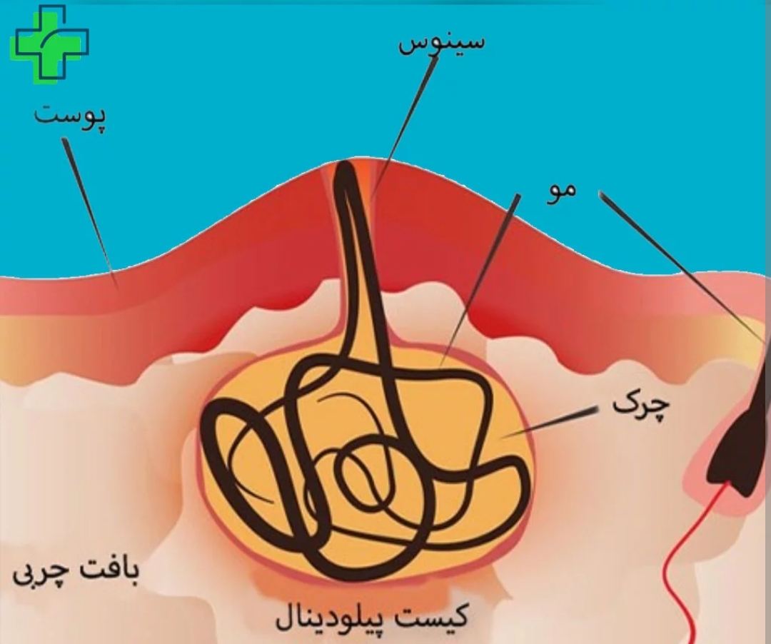 کیست پیلونیدالpilonidal sinus