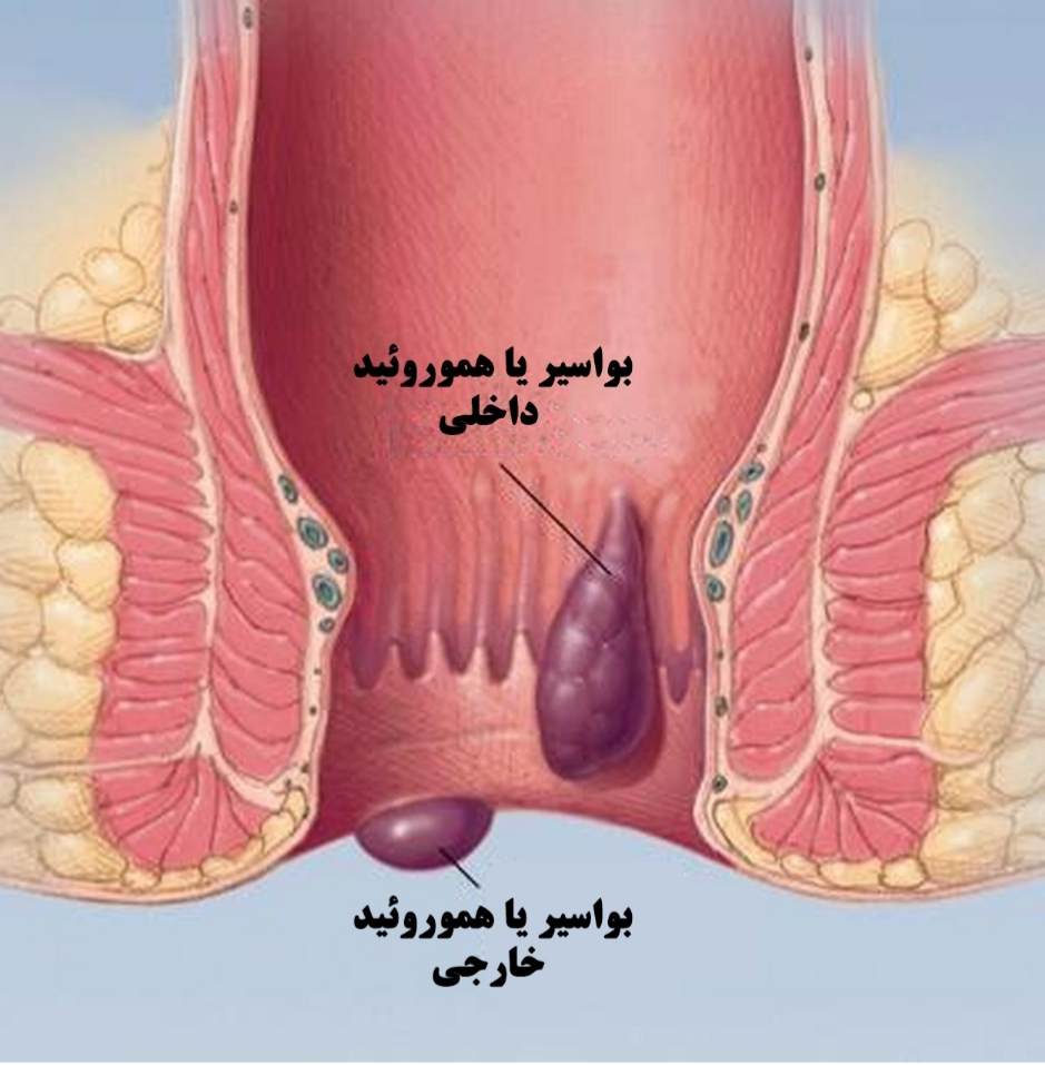 بواسیر داخلی و خارجی