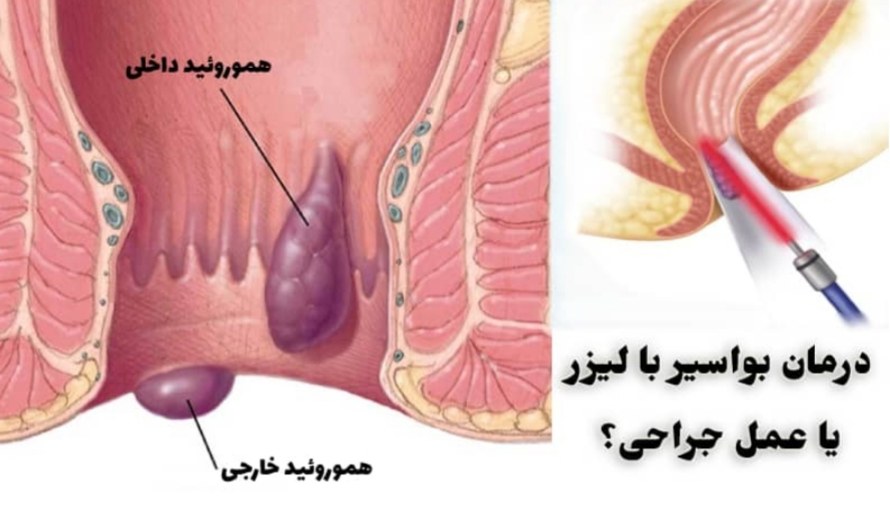 عمل بواسیر با لیزر