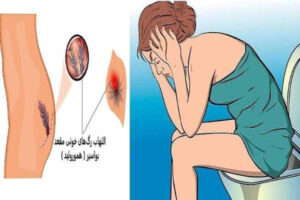 علائم بواسیر در خانم ها