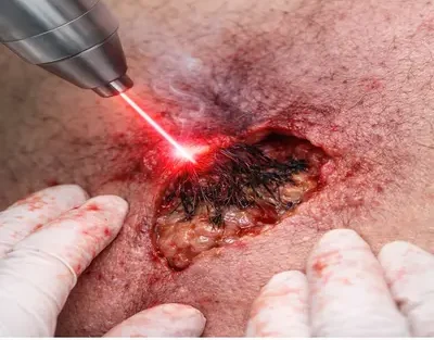 لیزر کیست مویی در تهران