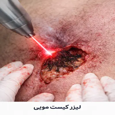 لیزر کیست مویی در تهران