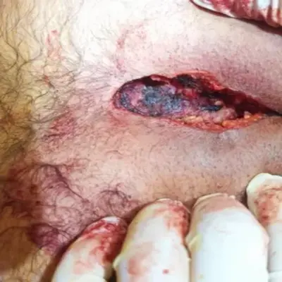 عفونت و آبسه گودی کمر؛ ترشح چرکی و زخم باز پوستی