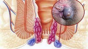 علائم بواسیر در مردان