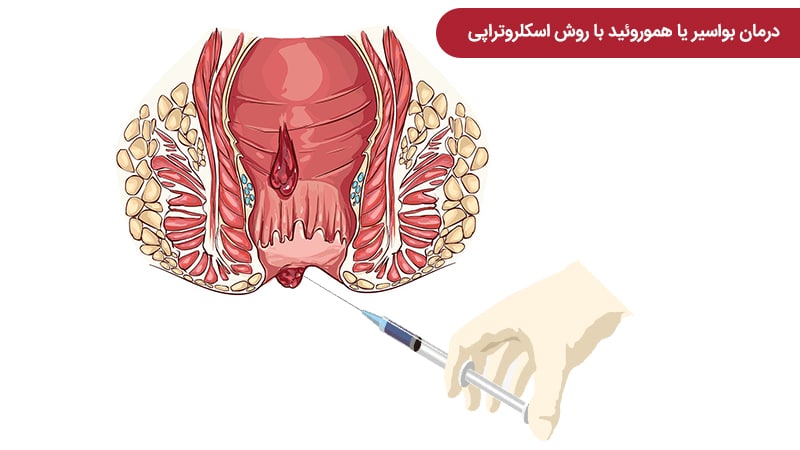 لیزر بواسیر یا هموروئید