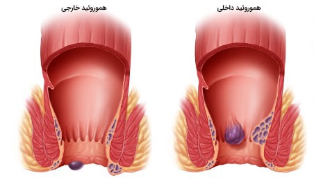 درمان بواسیر بعد از رابطه مقعدی