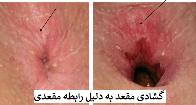 علت بی اختیاری مدفوع در زنان