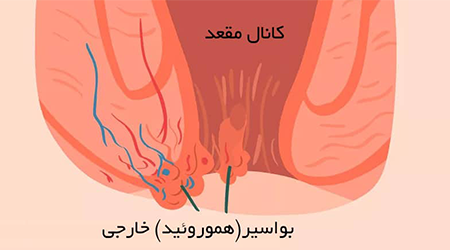 بواسیر خارجی یا هموروئید چگونه بوجود میاد؟