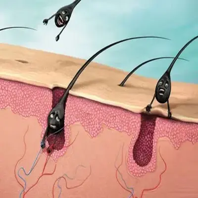 عکس عفونت کیست مویی بعد از عمل