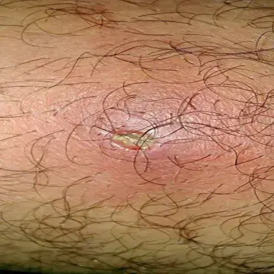 عکس عفونت کیست مویی بعد از عمل