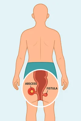 محل دقیق شقاق و آبسه در بدن انسان از پشت