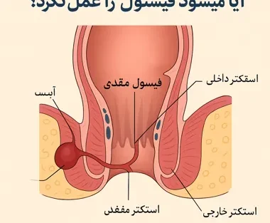 آیا میشود فیستول را عمل نکرد؟