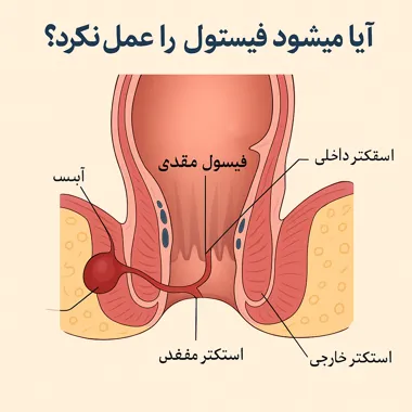 آیا میشود فیستول را عمل نکرد؟