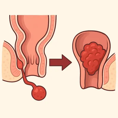 تبدیل فیستول مقعدی به سرطان مقعد