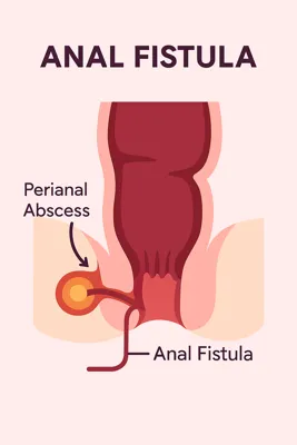 مدل آموزشی فیستول مقعدی و آبسه پرینال