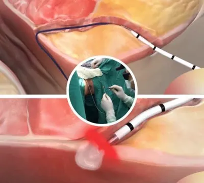 تصویر شماتیک لیزر فیستول مقعدی در زنان