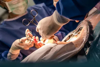 بیماری فیستول مقعدی در زنان