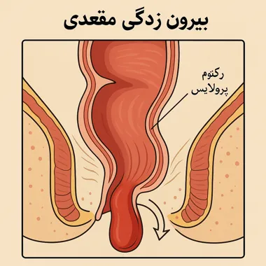 بیرون‌زدگی مقعدی