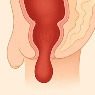 بیرونزدگی مقعدی تصویر شماتیک