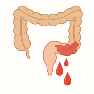 التهاب مقعد و خونریزی رکتوم در بیماری‌های نشیمنگاهی