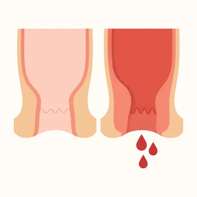 مقایسه رکتوم سالم با التهاب و خونریزی نشیمنگاهی