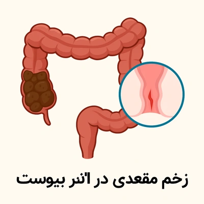 التهاب و درد نشیمنگاه ناشی از خشکی مدفوع