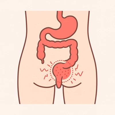 التهاب پوستی و سوزش ناحیه نشیمنگاه به صورت شماتیک آموزشی