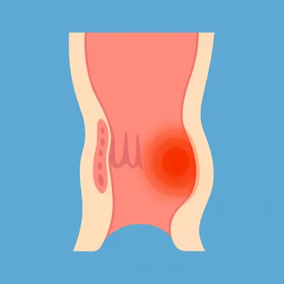 التهاب و قرمزی بافت نشیمنگاهی و نشانههای درد مقعد