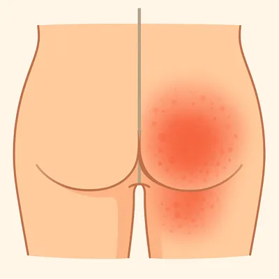 مقایسه پوست سالم و التهاب ناحیه نشیمنگاه با سوزش و قرمزی