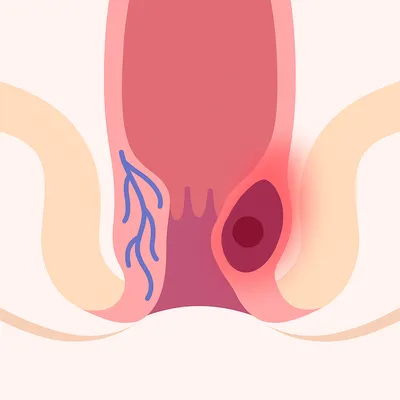 تورم رگ‌های ملتهب با لخته خون و درد نشیمنگاه