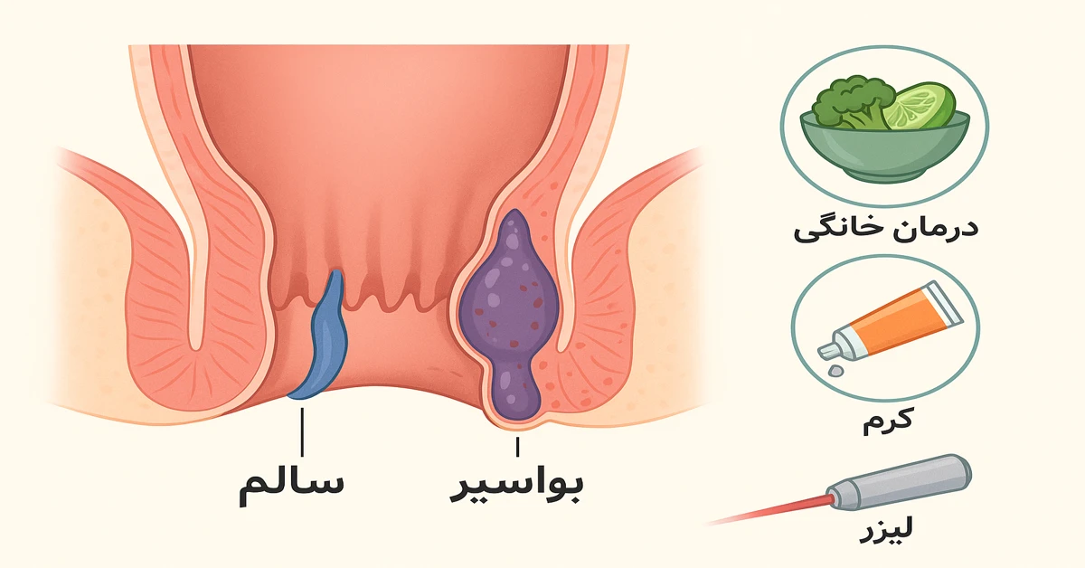 بواسیر چیست و چگونه درمان میشود – تصویر علمی درمان بواسیر