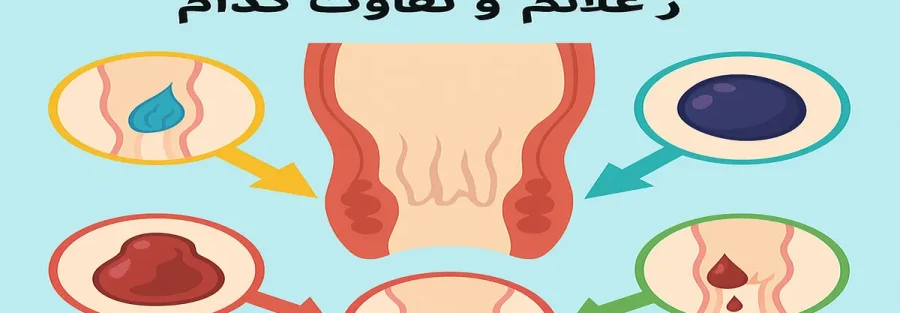 انواع بواسیر