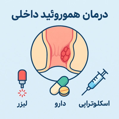 درمان هموروئید داخلی با لیزر، دارو و اسکلروتراپی