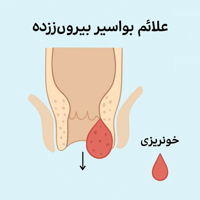 علائم بواسیر بیرون‌زده و نشانه‌های پرولاپس هموروئید