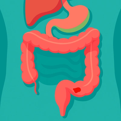 نمای شماتیک روده بزرگ با لکه خون و التهاب داخلی