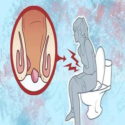 تصویر شماتیک درد ناحیه نشیمنگاه هنگام اجابت مزاج