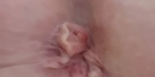 لیزر بواسیر خارجی