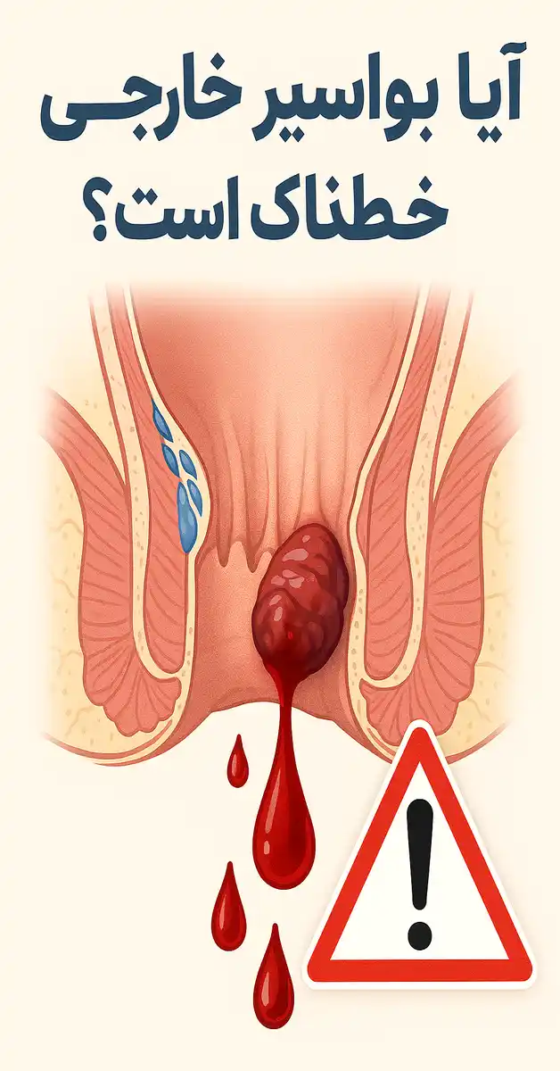 آیا بواسیر خارجی خطرناک است